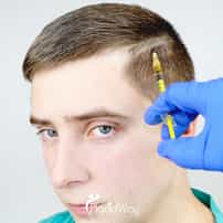 Stem Cell Therapy for Hair Regrowth in Japan: A Guide to Regenerative Restoration